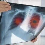 Akciğer kanseri erken teşhis edilmiyor: Hastaların %60’ında hastalık ileri aşamada belirleniyor