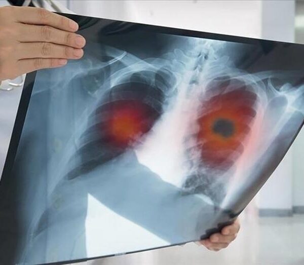 Akciğer kanseri erken teşhis edilmiyor: Hastaların %60’ında hastalık ileri aşamada belirleniyor