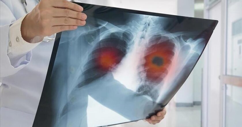 Akciğer kanseri erken teşhis edilmiyor: Hastaların %60’ında hastalık ileri aşamada belirleniyor
